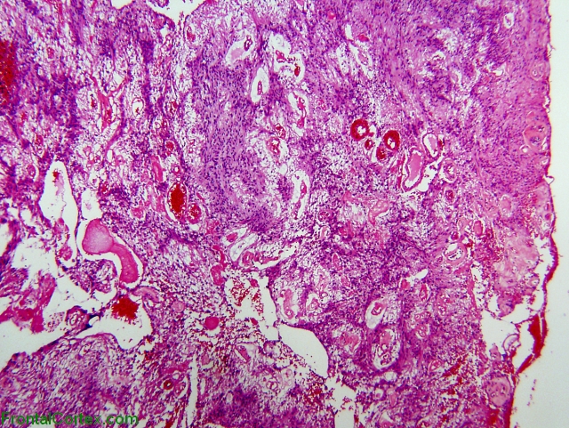 Myxopapillary ependymoma x40